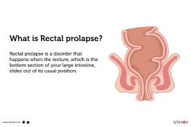 Image result for Rectal prolapse