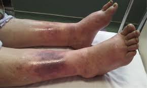 Image result for Edema