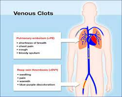 What Is A Blood Clot Unc Hemophilia And Thrombosis Center
