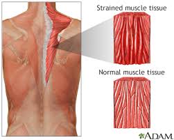 In order to heal the fastest, you have to not use the muscle at all. Strains Information Mount Sinai New York