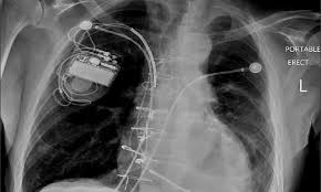 The pleura is a thin membrane between the lungs and chest wall that lubricates these surfaces and allows movement of the lungs while breathing. Amiodarone Induced Loculated Pleural Effusion Without Pulmonary Parenchymal Involvement A Case Report And Literature Review Journal Of Natural Science Biology And Medicine
