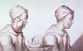 If breast cancer is diagnosed, other tests are done to find out if cancer cells have spread within the breast or to other parts of the body. History Of Cancer Wikipedia
