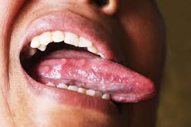Bulto Debajo De La Lengua Causas