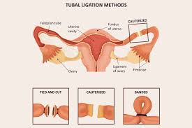 Tubal Ligation Benefits Risks And Alternatives