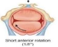 Image result for Manual Rotation in Occipitoposterior Presentation