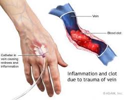 Superficial Phlebitis Photos Thrombophlebitis Treatment Sclerotherapy Varicose Vein Symptoms