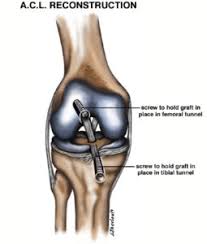 The most common grafts are autografts. Customised Acl Surgery Orthopaedic Surgeon Sunshine Coast Dr Steve Lawrie