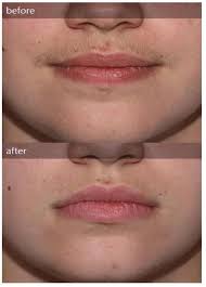 As with any other cosmetic procedure, laser hair removal can cause some side effects and discomforts that will vary from person to person. Hair Removal In Oxford Just Got Better Bare Uk