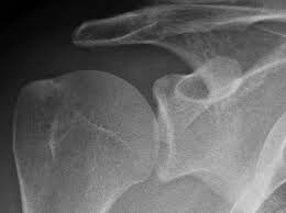 Schleimbeutelentzundung Der Schulter Subakromiale Bursitis Www Gelenk Doktor De