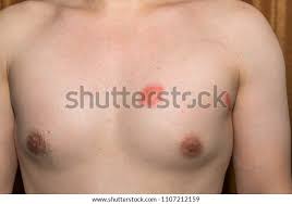 Image result for zoster under breasts
