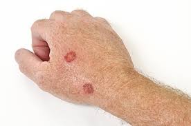 You might have many other specialists on your treatment team as well, including physician assistants (pas), nurse. Skin Cancer Types 360 Dermatology