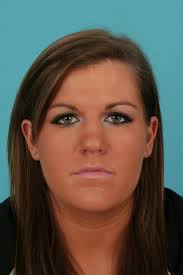 Rhinoplasty Case Examples