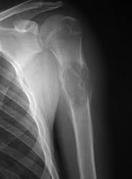 Extra Chemo Drugs Don T Improve Treatment Of Rare Bone Cancer Scope