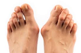 Als letzte option wird bei bereits stark verformten zehen meist eine operation durchgeführt. Hallux Valgus Ortho Pede Zentrum Fur Fuss Und Sprunggelenk
