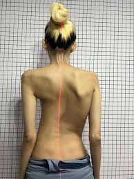  اعوجاج العمود الفقري