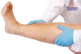 Image result for Compartment Syndrome