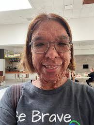 Faces of Neurofibromatosis