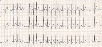 581 327 tykkäystä · 16 750 puhuu tästä. Atriale Tachykardien Fokus Ekg