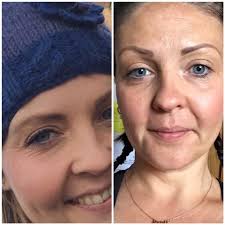 The best part is there are no reported serious side effects of collagen supplements. Before And After 6 Weeks Of Ingesting Absolute Collagen Real People Real Results Collagen Supplements Liquid Collagen Supplements Collagen