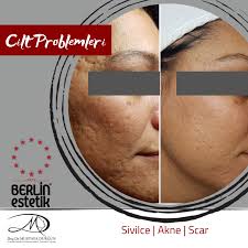 Cilt Yenleme Scar Izi Sivilce Izi Cilt Bakimi Estetik