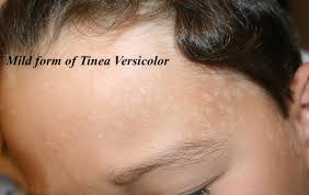 Pityriasis lichenoides et varioliformis acuta is a disease of the immune system. Ketoconazole For Pityriasis Aka Tinea Versicolor And Dandruff Aka Seborrhoeic Dermatitis