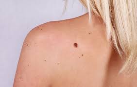 Skin cancer — the abnormal growth of skin cells — most often develops on skin exposed to the sun. Skin Cancer Surprising Causes Women S Health