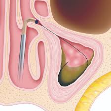 Image result for Sinus Surgery