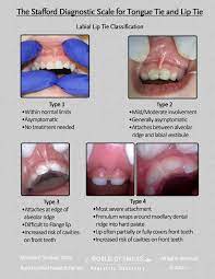 Diagnostic Scale For Lip And Tongue Tie Pediatric Dentist In Norwell Ma Hingham Pediatric Dentistry Dr Caroline Tongue Tie Pediatric Dentist Pediatrics