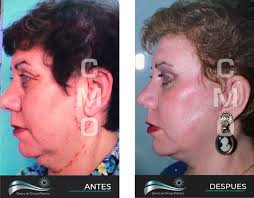 Rejuvenecimiento Facial