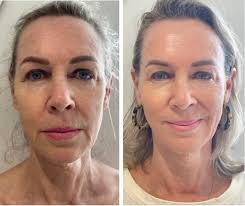 What is HIFU? Everything You Need to Know About This Revolutionary Skin  Treatment