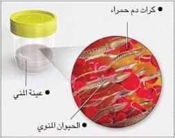 هل له أي أضرار؟ أضرار العادة سرية Ø§Ù„Ø¯Ù… ÙÙŠ Ø§Ù„Ø³Ø§Ø¦Ù„ Ø§Ù„Ù…Ù†ÙˆÙŠ Ù‡Ù„ Ø¹Ù„ÙŠÙƒ Ø§Ù„Ù‚Ù„Ù‚ Ù‡Ù„ ÙŠÙ‚Ù„Ù‚Ùƒ Ø¸Ù‡ÙˆØ± Ø¨Ø¶Ø¹ Ù‚Ø·Ø±Ø§Øª Ù…Ù† Ø§Ù„Ø¯Ù… ÙÙŠ Ø³Ø§Ø¦Ù„Ùƒ Ø§Ù„Ù…Ù†ÙˆÙŠ Ø¥Ù„ÙŠÙƒ Ø£Ø¨Ø±Ø² Ø§Ù„Ø£Ø³Ø¨Ø§Ø¨ Ø§Ù„Ù…Ø­ØªÙ…Ù„Ø© Ù„Ù‡Ø°Ø§ Ø§Ù„Ù…Ø±Ø¶ ÙˆØ§Ù„Ø£Ø¹Ø±Ø§Ø¶ Ø§Ù„Ù…Ø±Ø§ÙÙ‚Ø© Ù„Ù‡ ÙˆØ·Ø±Ù‚ Ø¹Ù„Ø§Ø¬Ù‡ Ø§Ù„Ø¯Ù… ÙÙŠ Ø§Ù„Ø³Ø§Ø¦Ù„ Ø§Ù„Ù…Ù†ÙˆÙŠ