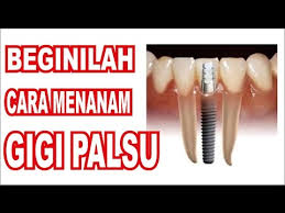 Maybe you would like to learn more about one of these? Beginilah Cara Menanam Gigi Palsu By Afiq Al Fatih