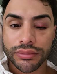 Alguém já teve um terçol desses? O que fizeram pra curar?