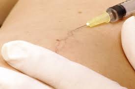 U ppl ement(s) provides for: Injection Sclerotherapy Nj Top Spider Vein Doctors In Morris County