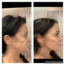 Facelift/Neck Lift Albuquerque NM, D. Eric Tuggle, D.D.S.
