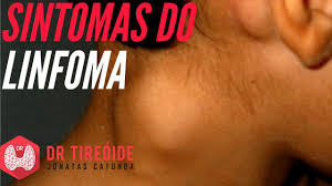 Se os sintomas forem persistentes, uma avaliação para determinar sua causa. Linfoma Entenda Os Sintomas Dr Jonatas Catunda Youtube