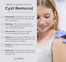 Learn the do's and don'ts of treating this common skin problem. What To Expect From A Cyst Removal The Best Cyst Removal Treatment