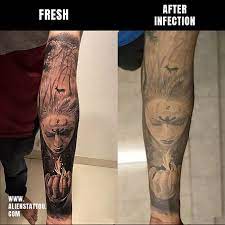 Ideas + reccomendations on steve. Tattoo Aftercare Bad Affects Tattoo Scabbing Tattoo Aftercare Infected Tattoo