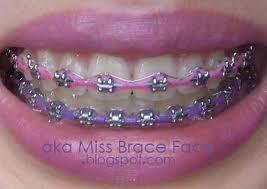 Black And Purple Braces Color Cute Braces Colors For Girls Teeth Google Search Cute Braces Colors Cute Braces Braces Colors