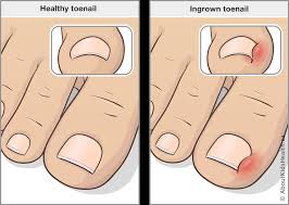 Before you do anything, assess the damage. Ingrown Toenail