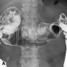 Peritoneal mesothelioma is an abdominal cancer caused when asbestos fibers irritate the lining of the abdomen. Colonic Invasion Of Malignant Peritoneal Mesothelioma Gastrointestinal Endoscopy