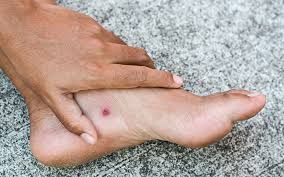 Image result for Skin Ulcer