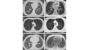 Nodules may develop in one lung or both. Lung Mri In Parenchymal Disease