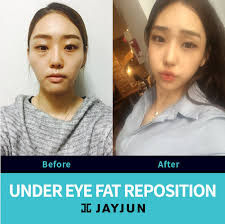 Korea Upper Eyelid Surgery Korea Lower Eyelid Surgery Korea Eye Surgery Before And After Korea Eye Surgery K Eyelid Surgery Upper Eyelid Laser Eye Surgery Cost