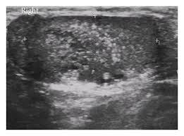 Tert is usually associated with epididymal pathologies such as epididymal cyst or spermatocele located on the same side. A Case Of Cystic Dysplasia Of The Rete Testis In A 17 Months Old Boy