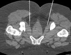 Image result for Pudendal Block