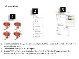 Getting a diagnosis of bladder cancer can be a difficult time. 0914 Stages Of Prostate Cancer Medical Images For Powerpoint Powerpoint Templates Download Ppt Background Template Graphics Presentation