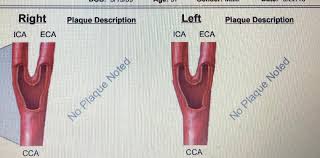 Like pipes in your home or car, arteries can. Reversal Of Clogged Arteries Is Real Pictures Worth A 1000 Words By Joel Kahn Medium