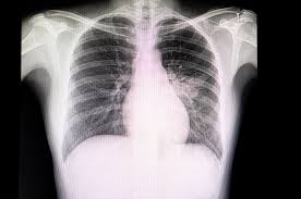 Image result for Chest XRay