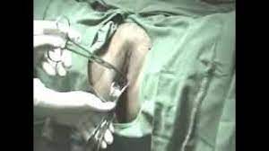 While this process might seem overwhelming, there are a slew of things you can do to make your iud insertion easier and less painful. Procedure Videos Dr Jeff M D